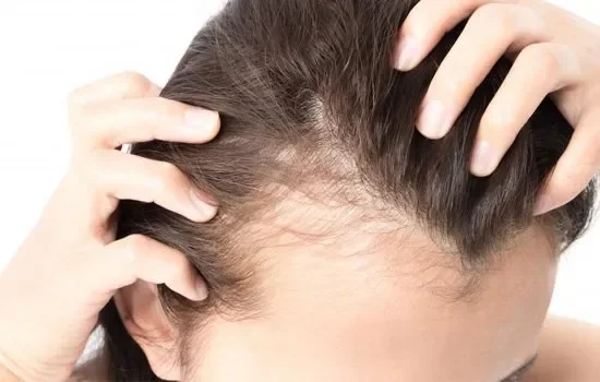 hair loss after menopause