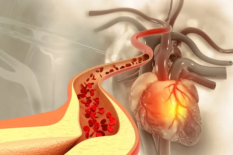 Heart Attacks & Strokes: 99% Linked to 4 Key Risk Factors