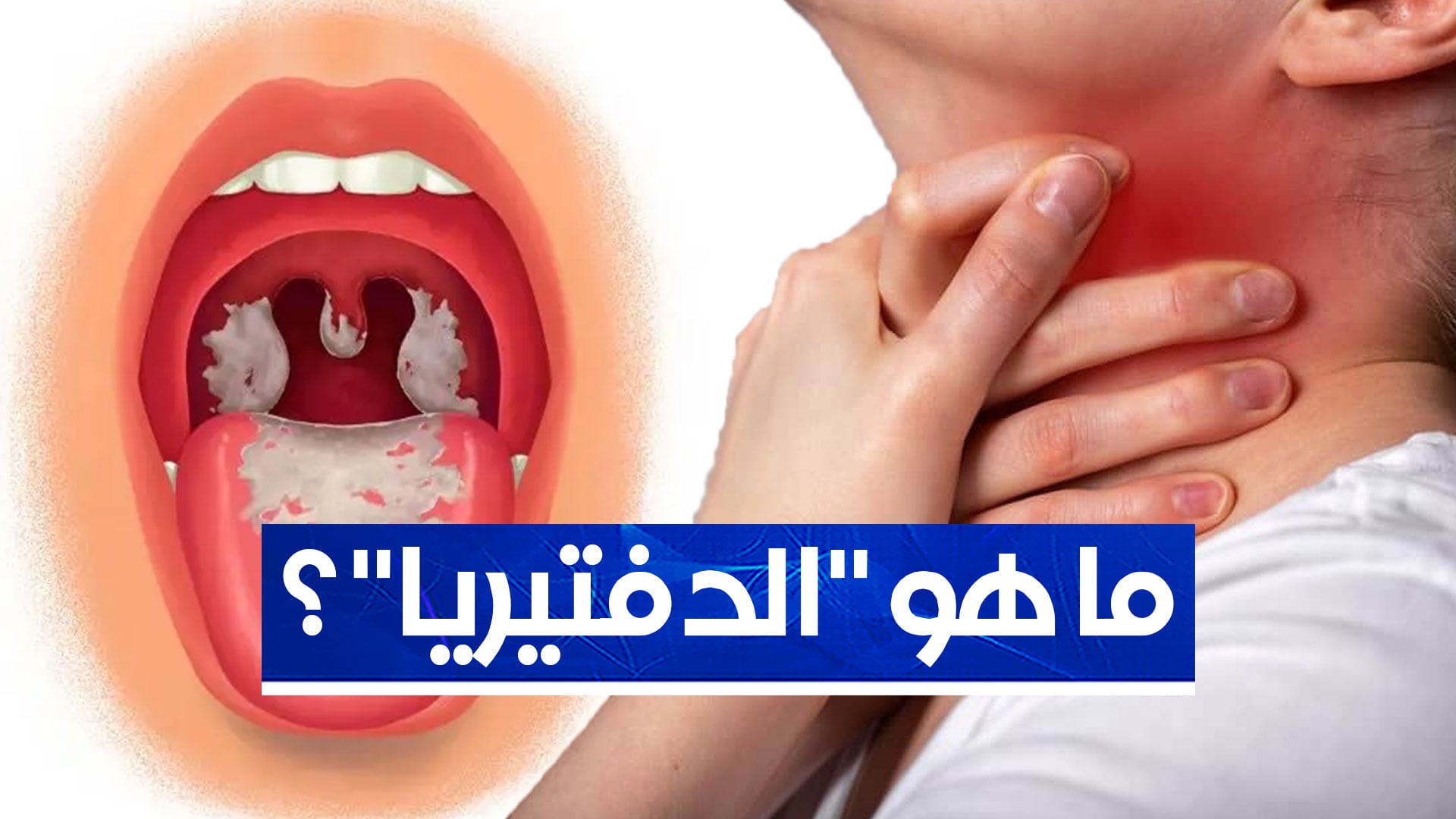 Diphtheria: Understanding the Disease and its Impact