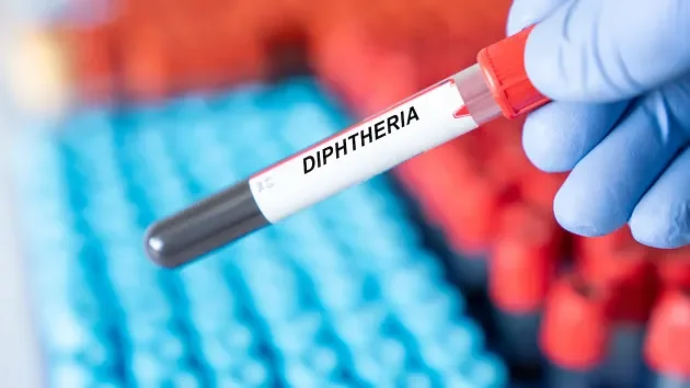 Diphtheria Alert: Cases Reported in Algeria, What You Need to Know