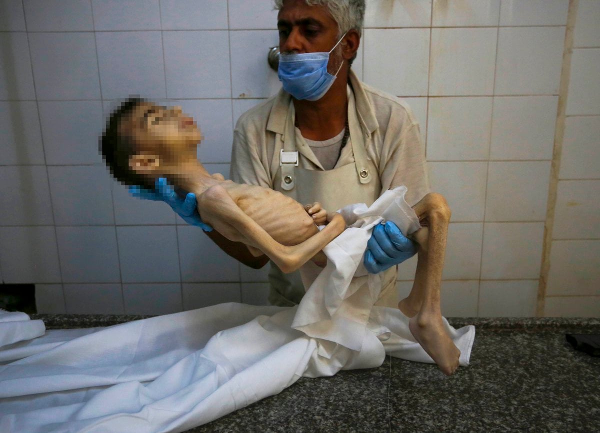 Gaza: WHO Reports 421 Malnutrition Deaths Amid Conflict
