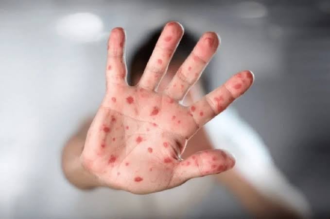 Africa Ends Public Health Emergency for Mpox