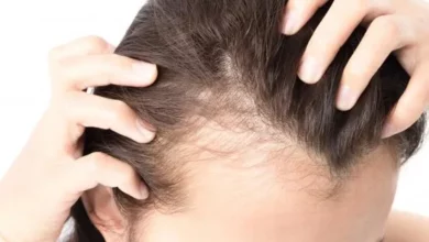 hair loss after menopause